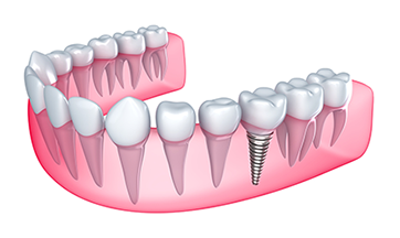 dental implants in Jericho, VT